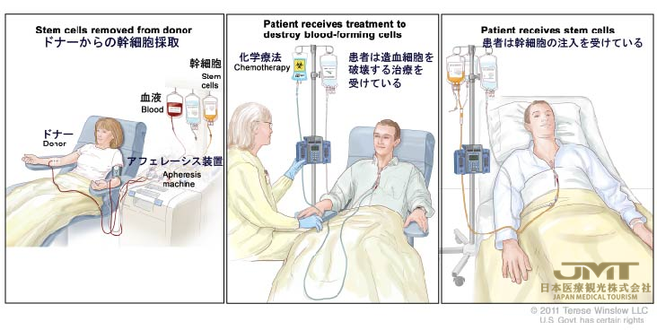 日本癌症治疗——成人非霍奇金淋巴瘤的治疗④