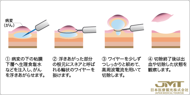 JMT日本干细胞————大肠癌（结肠癌·直肠癌）的内镜治疗详解
