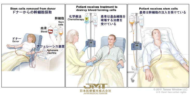 JMT日本干细胞——成人急性髓系白血病的治疗方案概述①
