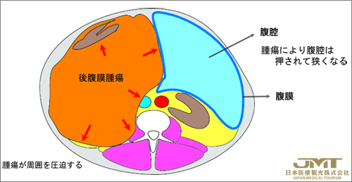 JMT日本干细胞——关于腹膜后肉瘤的症状、诊断与治疗