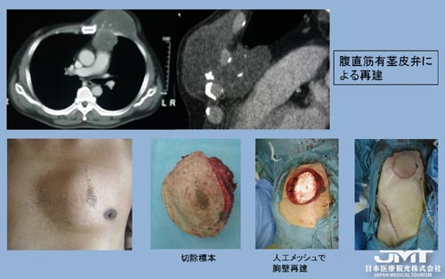 JMT日本干细胞——关于躯干肉瘤的症状、类型、诊断与治疗（下）